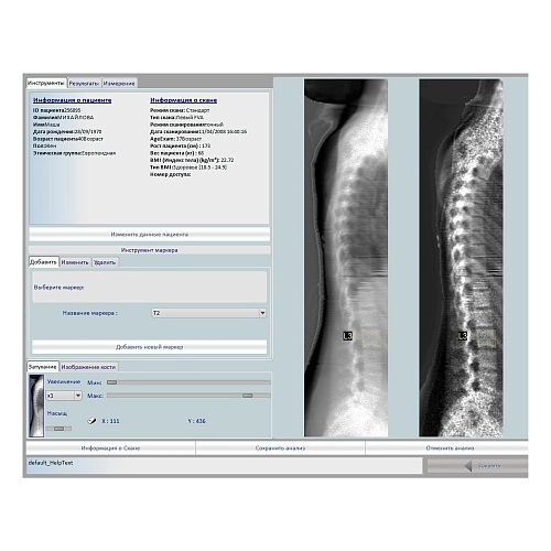 Остеоденситометр Stratos DR