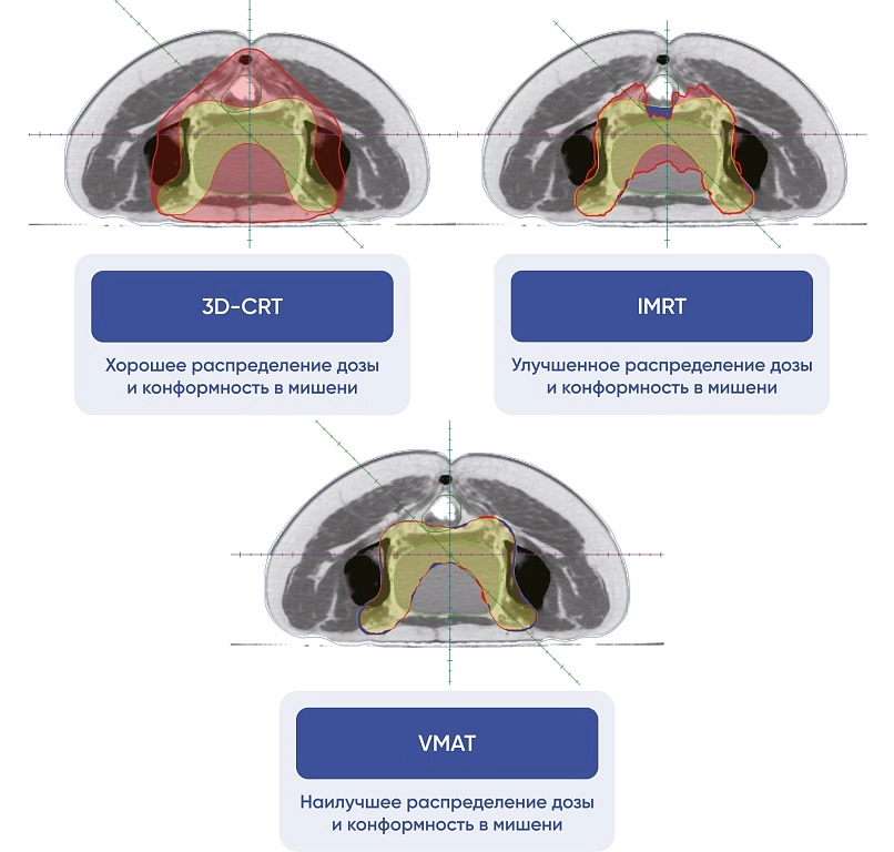 Сравнение методик лучевой терапии