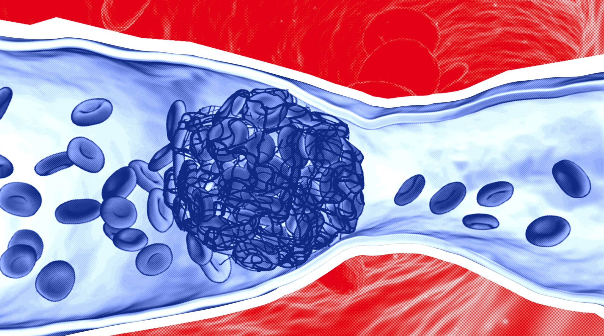 Что такое тромб: как образуется, чем опасен и как лечить
