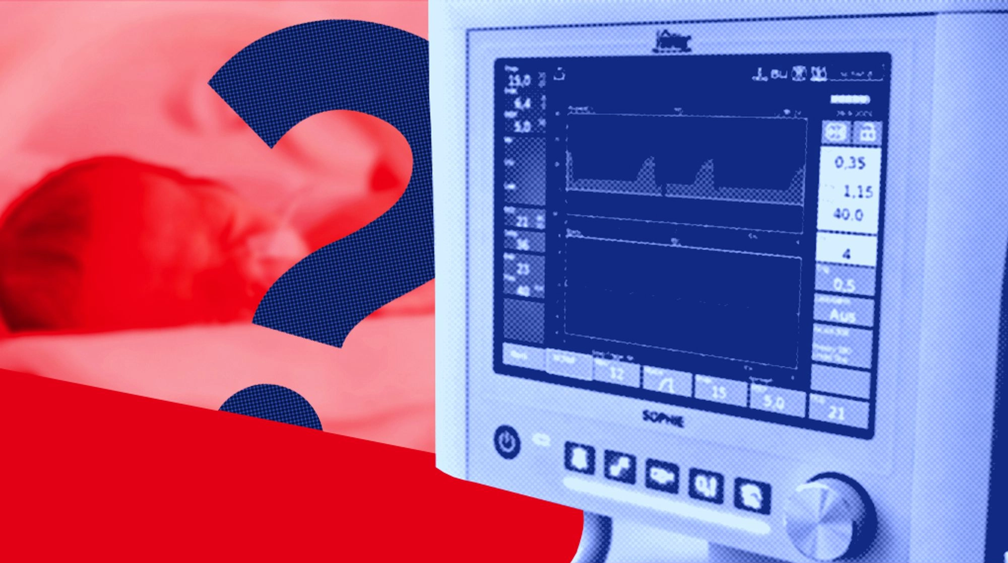 Как работает аппарат искусственной вентиляции легких